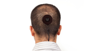 That NYU Professor With a Camera Surgically Attached to His Head? Yeah, His Body's Rejecting It